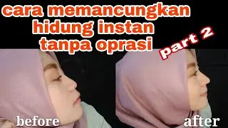 HIDUNG MANCUNG TANPA OPRASI (PART 2)