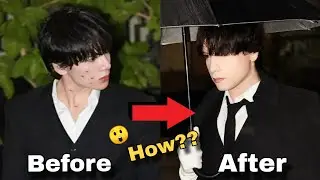 How to Remove PIMPLE NATURALLY FAST ?? * Reality *