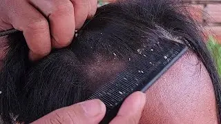 ASMR Scalp Scratching for Sleep and Relaxing Care #E414