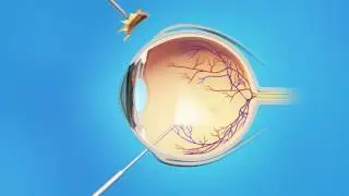 RCA & the AAO Present Retina Macular Pucker Vitrectomy