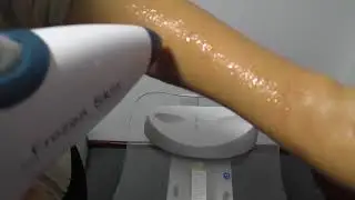 frozen skin beauty gun