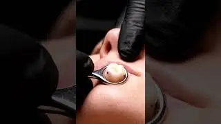 Blackhead Removal #asmr #satisfying #calm #pimple #blackheads #extraction #piercing #skincare