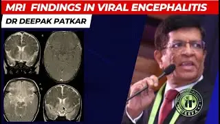 DR DEEPAK PATKAR || CNS INFECTIONS - Viral Encephalitis