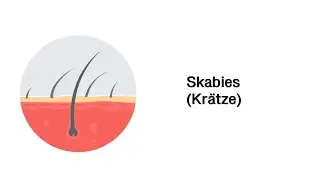 Skabies (Krätze) - Erkrankungen der Haut
