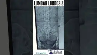 Lumbar lordosis - back pain - xray finding #shorts #backpain #lordosis #xray #posture #drsuniltank
