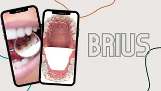 Brius - new braces alternative?! #shorts