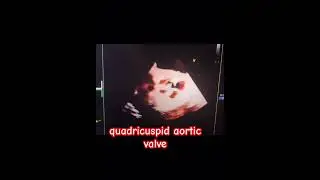 &ldquo;quadricuspid aortic valve.&rdquo; #cardiology #echocardiography  #heartmonitoring @SafaMedicalLecture