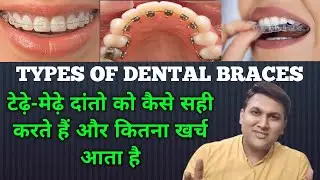 Types of Dental Braces(in Hindi) || Cost of Braces