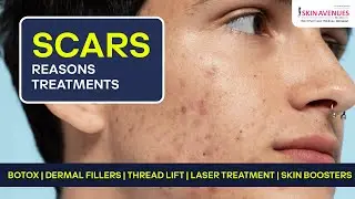 Laser Scar Treatment: Say Goodbye to Scars with Dr. Shraddha Samant! #skincare #laser #skincaretips