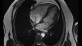 Multimodality Imaging of an Unknown Right Atrial Mass - video 4