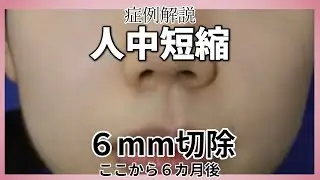 鼻下の整形。人中短縮術　6か月の症例解説。名古屋こいずみ形成クリニック