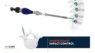 Accelus: LineSider&reg; Spinal System