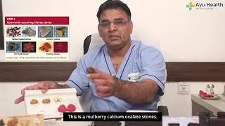 What are different types of kidney stones?