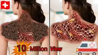 ASMR Animation | Removal Dog Tick Warm and Maggot from Infected back | Trypophobia Animation