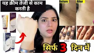 Skin को गोरा कैसे करे | Glycolic acid cream | Glycolic acid cream review | Glyco A | Glycolic acid