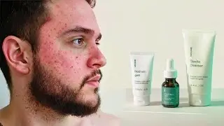 My Real-Life Rosacea Fix: A Guy's Guide to Finally Clearing Your Skin