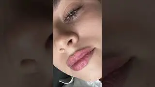 Russian Lip Filler Glasgow Scotland