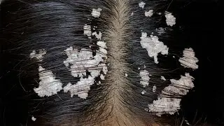 Hair Brushing & Scalp Scratching ASMR #S0001