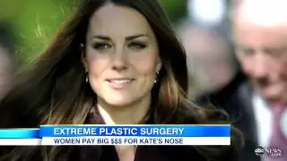 Kate Middleton Nose Job: Women Get Plastic Surgery to Look Like the Duches