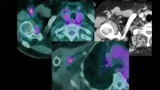 Atteinte du plexus brachial