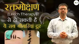 Leech Therapy in Ayurveda, skin & hair loss treatment