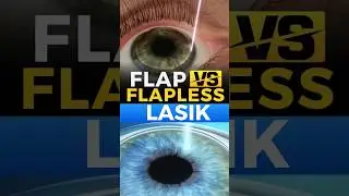 Flap V/S Flapless Lasik