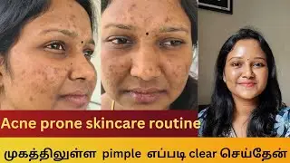 How I cleared my acne | Acne prone skincare routine | Products that I used for acne #acneproneskin