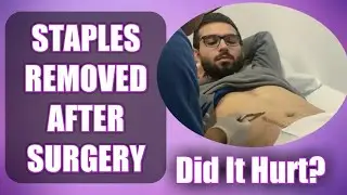Surgical Staples Removed - How Painful Was It? (What To Expect)