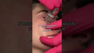 Sylfirm X: The Best Treatment For a Non Surgical Blepharoplasty?