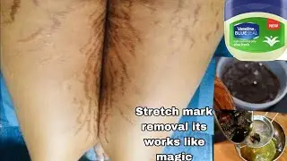 How To Get Rid Of Stretch Marks & Scars + DIY At Home Stretch mark  Get Rid of Starch mark in 3days