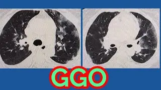 Ground Glass Opacities / CT chest / sk rad tech