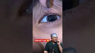 Dilated Pupils Explained | Why Doctors Dilate Eyes