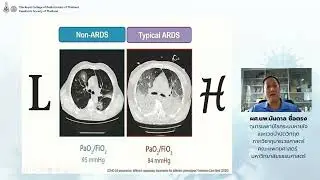 Interesting severe COVID cases in PICU-08042022