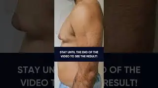 This patient underwent Grade 3 gynecomastia surgery with areola grafting.😮&zwj;💨