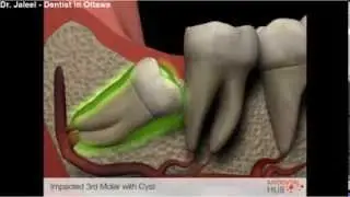 Oral Surgery - Impacted 3rd Molar Cyst - Dentist Ottawa