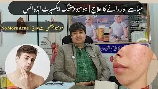 Acne Treatment in Homeopathy | Pimples Solution | Best Homeopathic Medicines for Clear Skin