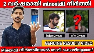 Minoxidil നിർത്തിയാൽ  താടി കൊഴിയുമോ😰| Minoxidil side effects after 2 years 2022
