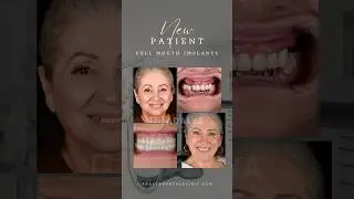 Dental Implants Turkey Antalya - Cost, Packages - Antalya dental Clinic #dentist