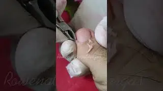 pedicure toenails #ingrown #nails #nailcare #dryskin