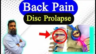 Disc Prolapse | Back Pain | Herniated disc