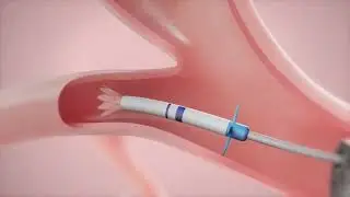Zephyr Valve: How It Works