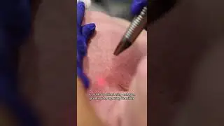 Erbium Resurfacing Laser - Chest, Neckline D&eacute;colletage Skin Rejuvenation Treatment