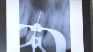Two Endodontic Cases: Dens Invaginatus and Saving a Tooth as Priority
