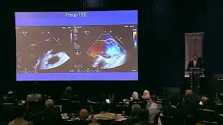 Remodeling of the root for BAV with severe AI and root aneurysm - Ismail El Hamamsy