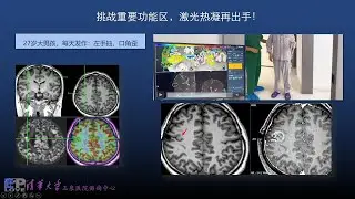 听周文静主任手术病例分享：挑战重要功能区，激光热凝再出手！