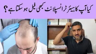 Can Hair Transplant be failed after Successful Procedure?