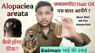 Jamalgota for Alopaciea areata treatment l best jamalgota Hair oil #bestjamalgotahairoil #alopecia