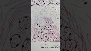 Capillary hemangioma histopathology