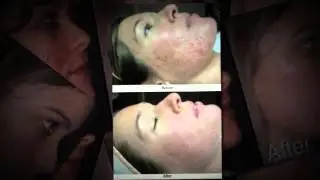 Albuquerque Acne Treatments