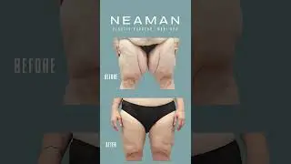 Thigh Lift at Neaman Plastic Surgery